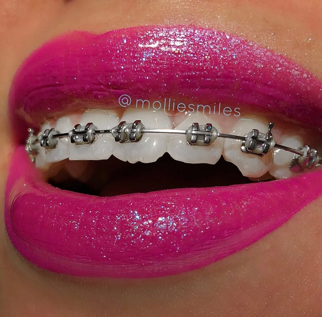 How To Keep Your Teeth Clean With Braces