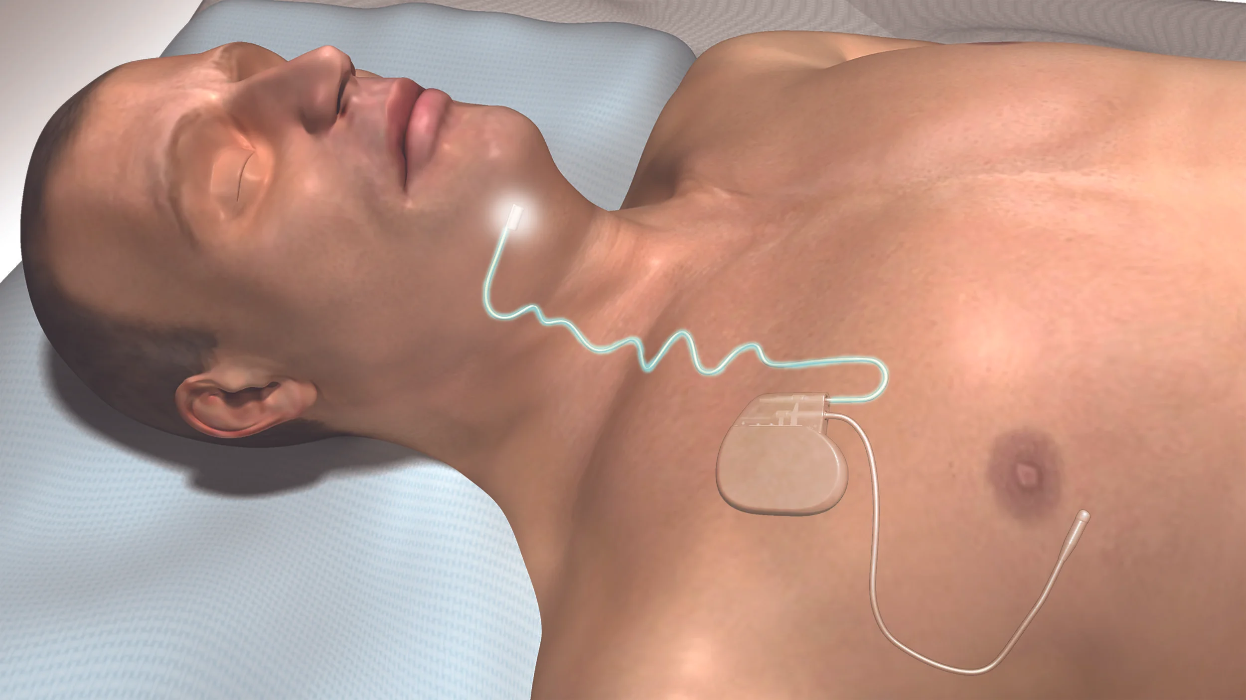 The Inspire System with Stimulation.jpg