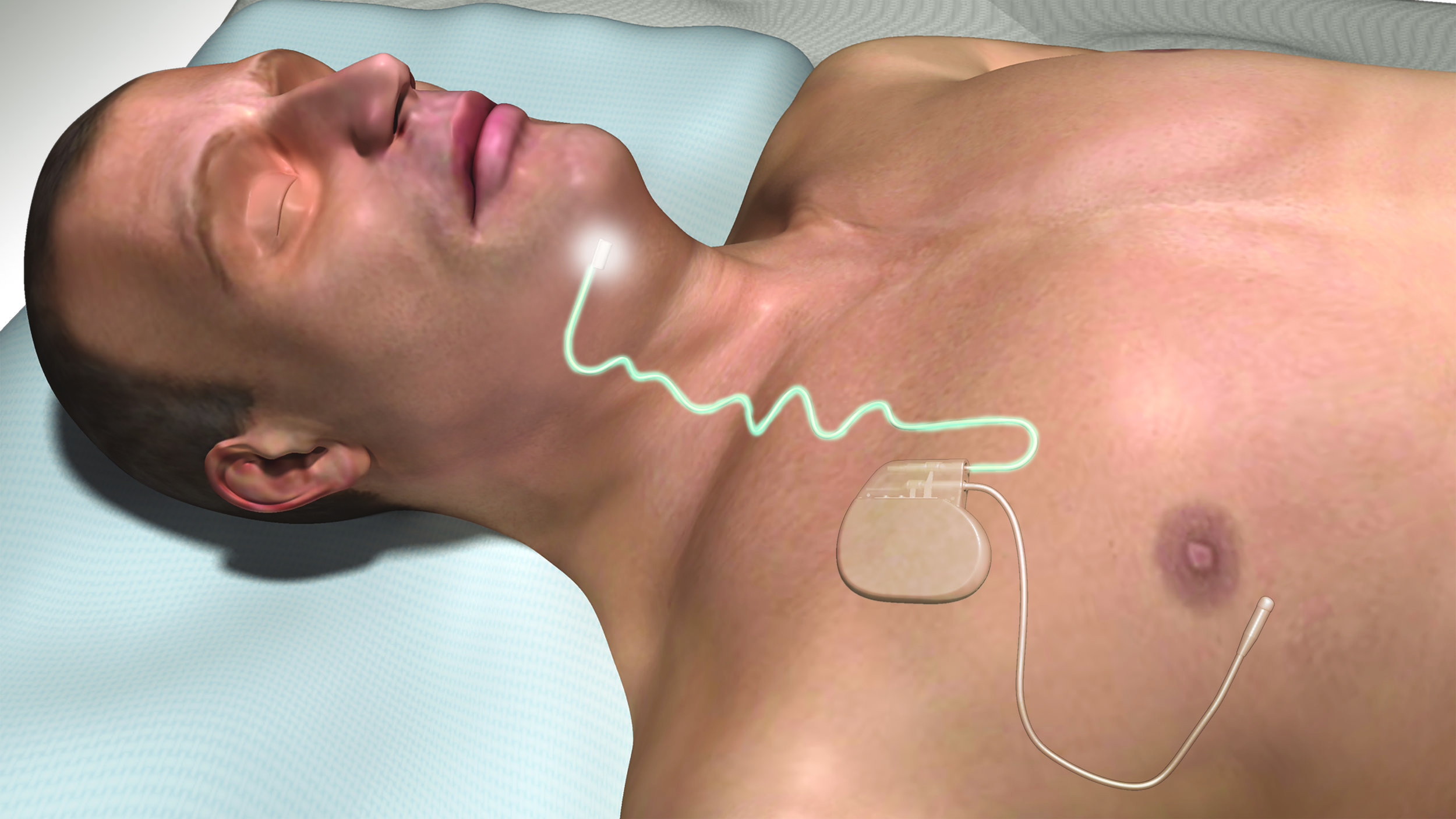 The Inspire System with Stimulation.jpg