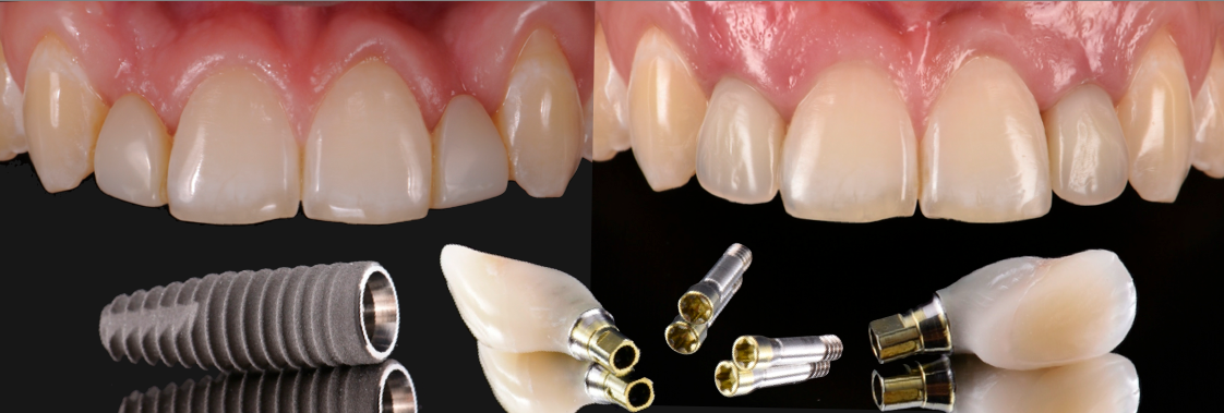 smart-bone-grafting.png