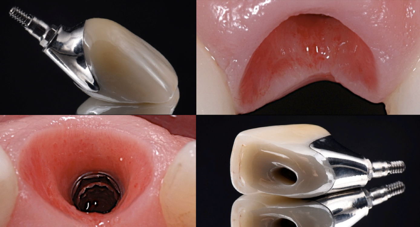 bone-grafting-dr-lee.png