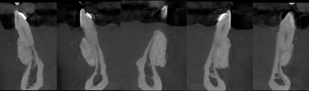 bone-grafting-example.png