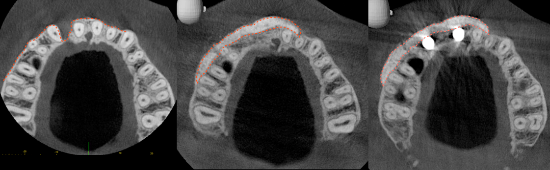 smart-bone-grafting-example.png