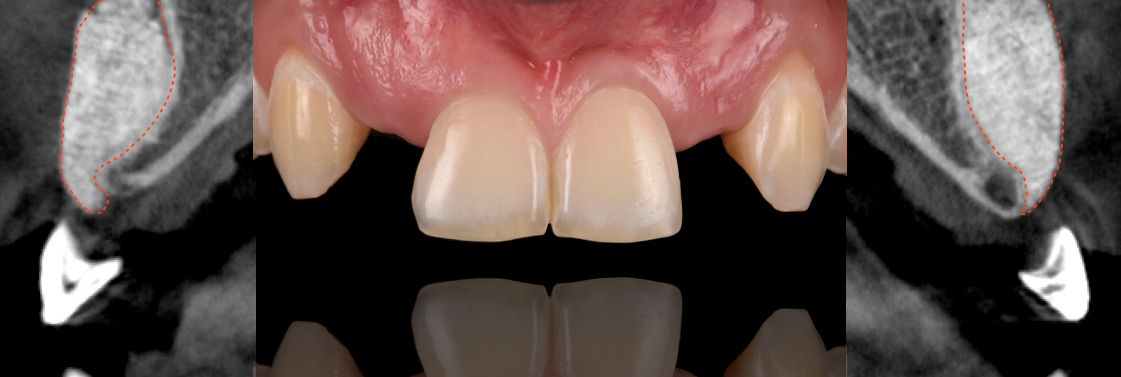 patient-smart-bone-grafting-dr-lee.png