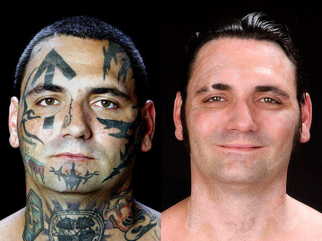 Mad Dog Tattoo Removal  Laser Tattoo Removal  Austin Texas