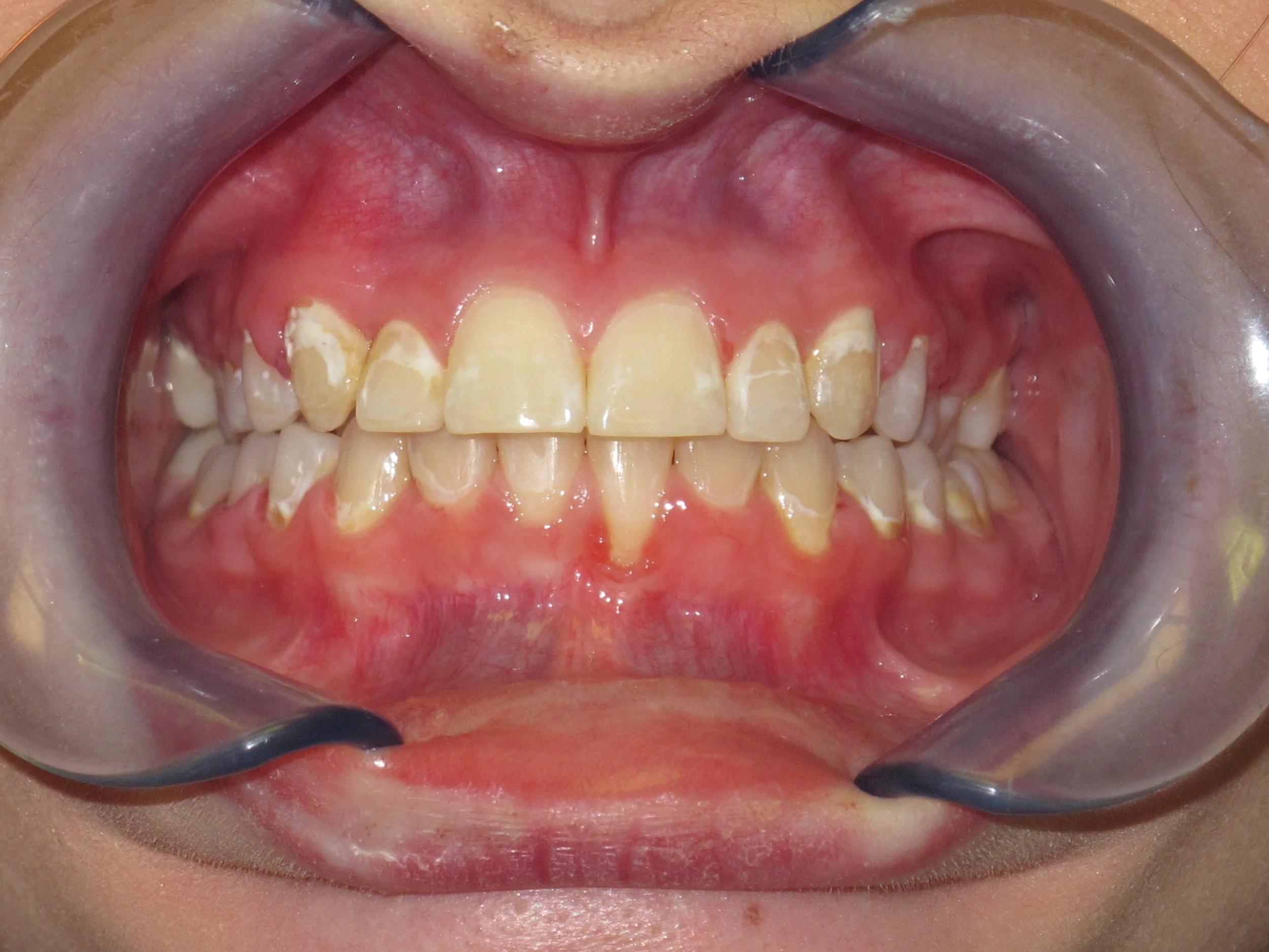 Diabetes and the Dentist