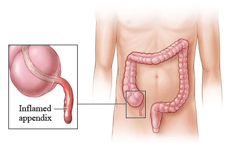 appendectomy-01.jpg