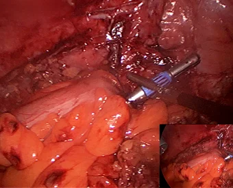 03_LSP_Colon-Resection_A1.jpg