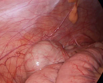fig 3: Colon