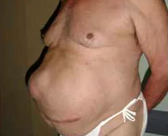03_LSP_Incisional-Hernia1.jpg