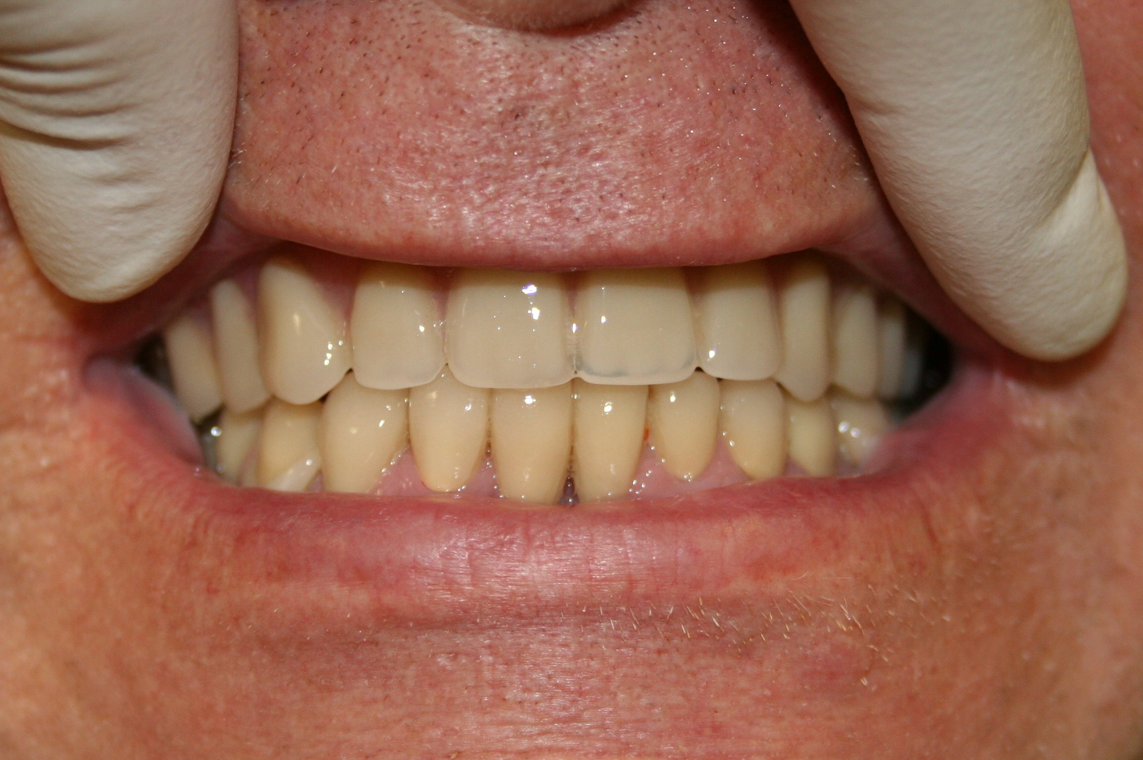 c-p crowns after.JPG