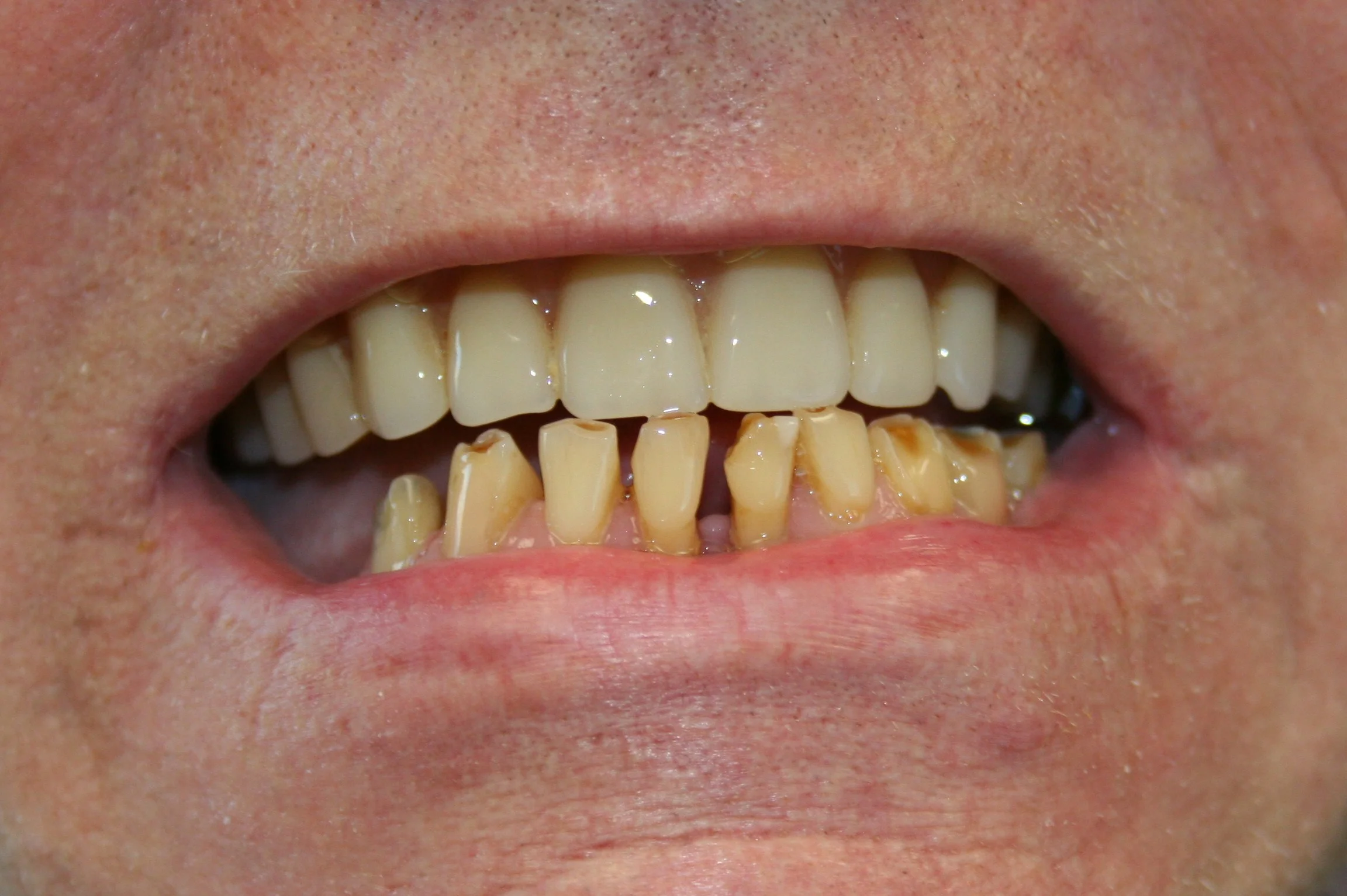 C-P crowns before.jpg