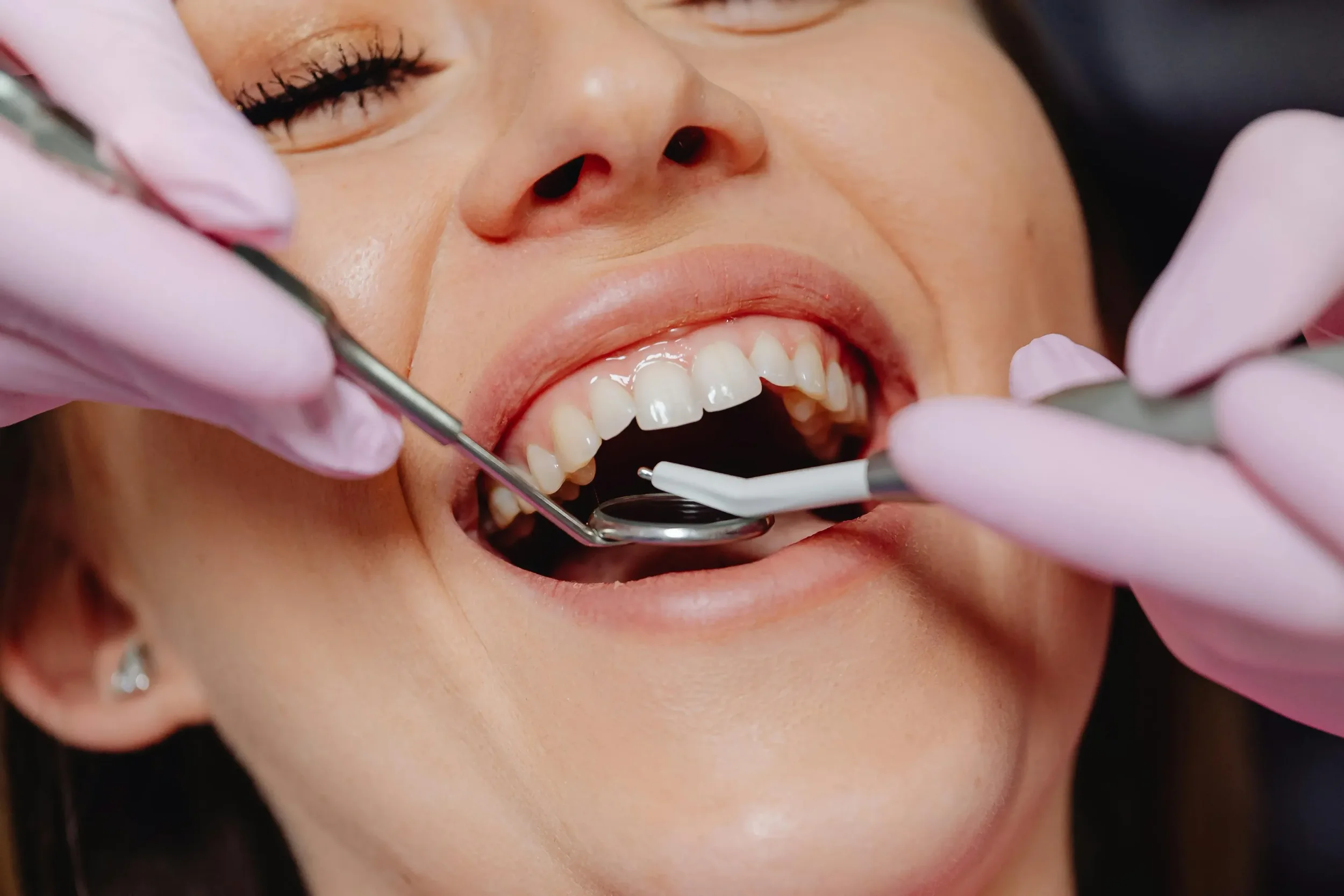 Close-up of a woman at the dentist with her mouth open, receiving dental cleaning. A dentist wearing pink gloves is using dental tools inside her mouth.