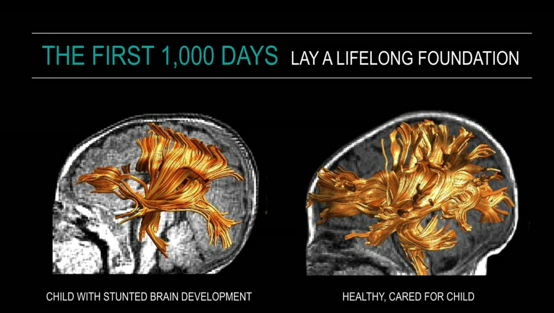 Brain images of white matter fibre tracks —&nbsp;compared between stunted growth (left) and normal growth (right) of three-month old Bangladeshi children.&nbsp;Picture © Nadine Gaab and A. Charles Nelson.&nbsp;Source: Dr. Charles A. Nelson, Harvard …