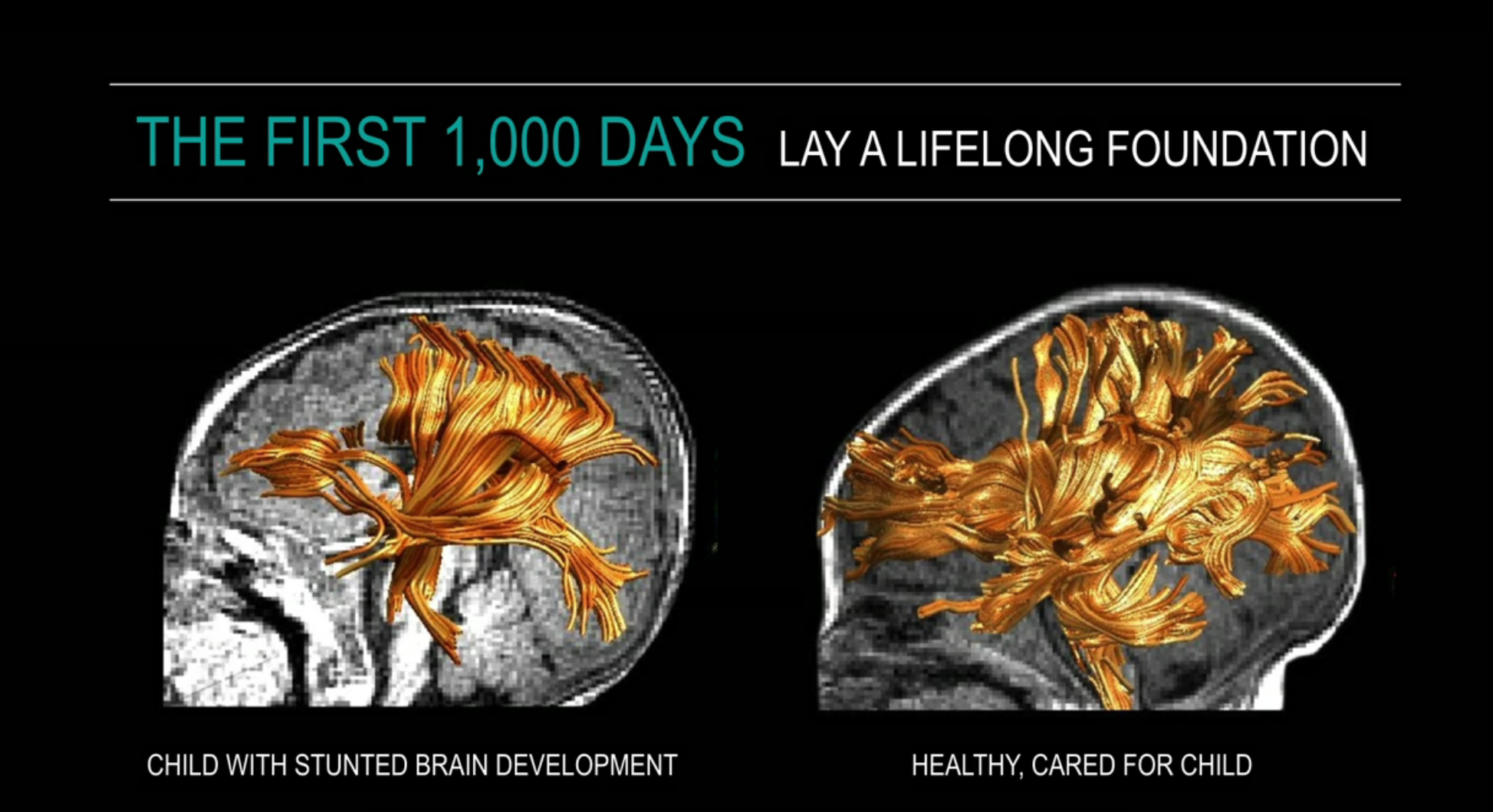 Brain images of white matter fibre tracks —&nbsp;compared between stunted growth (left) and normal growth (right) of three-month old Bangladeshi children.&nbsp;Picture © Nadine Gaab and A. Charles Nelson.&nbsp;Source: Dr. Charles A. Nelson, Harvard …