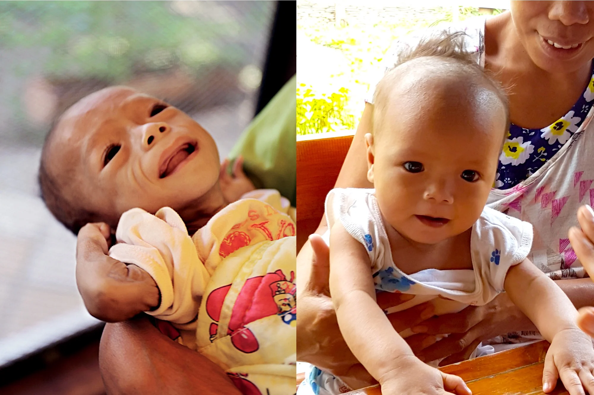 Joemar Bacaltos’ weight increased from 3.3 kg in August 2016 (left) to 6 kg in December 2016 (right) after beginning treatment for severe acute malnutrition.Photo source:&nbsp;Lotta Sylwander, UNICEF Philippines Country Representative ©UNICEF Philip…