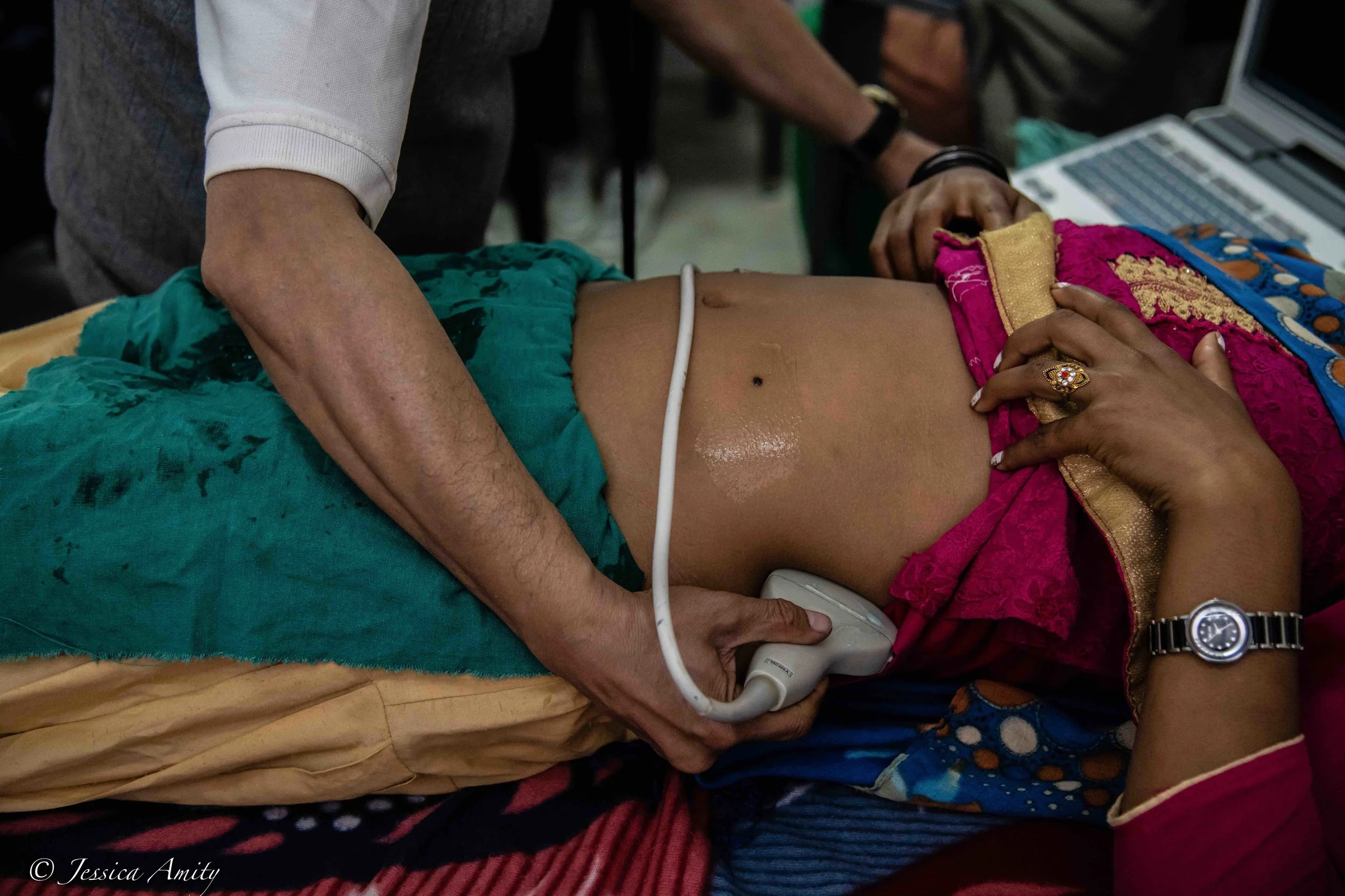 A picture of a young teenage girl receiving an ultrasound. It was found that she is a few weeks pregnant with her first child. She came into the camp alone with abdominal pain and was worried. According to the UNFPA girls aged 15-19 are twice as likely as women aged 20-24 to die during pregnancy. One of the common health risks of early pregnancy is fistula. Because young women are not physically developed enough to deliver a child, they often face prolonged labor. During labor, the baby exerts pressure against soft tissues in the mother's pelvis. This can cause some tissues to die, leaving a hole or a fistula. Another common problem associated with early pregnancy is uterine prolapse, which affects 600,000 women in Nepal. Among the causes of this condition are applying pressure during delivery, strenuous manual labor after childbirth, and giving birth and a young age. Some effects of uterine prolapse include pain during urination, difficulties during sexual intercourse and social stigmatization.