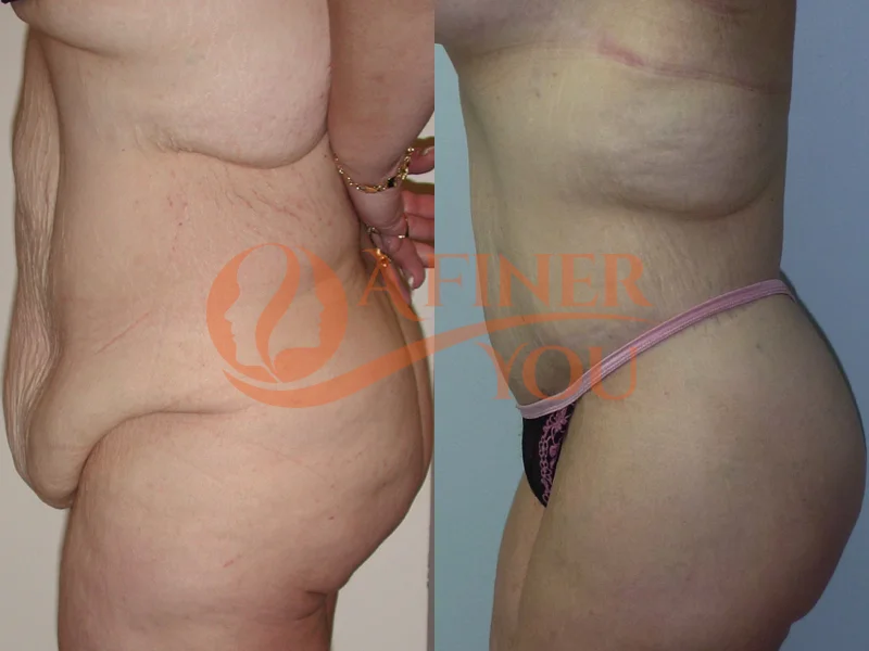 Bodylift 4 year results