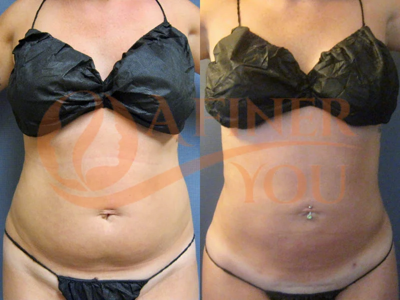 Liposuction waist with tumescent anesthesia 6 month result