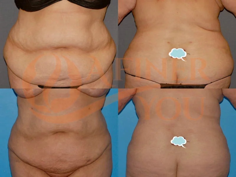 Liposuction Abdomen, Waist, Front and back bra roll, and sacral area 2 sessions with nearly 5 liters of fat taken out each time