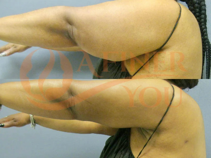 Liposuction arm 3 month result