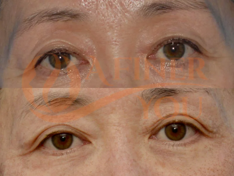 Fractionated CO2 to eyelids 4 day result
