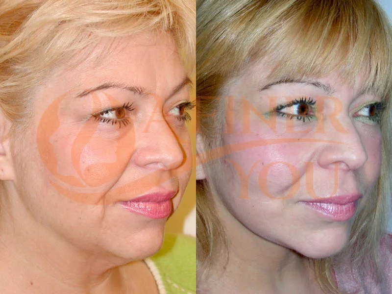 Facelift, upper and pinch lower blepharoplasty front and oblique view 1 year result