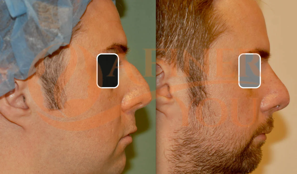 Rhinoplasty and spreader grafts 2 week result