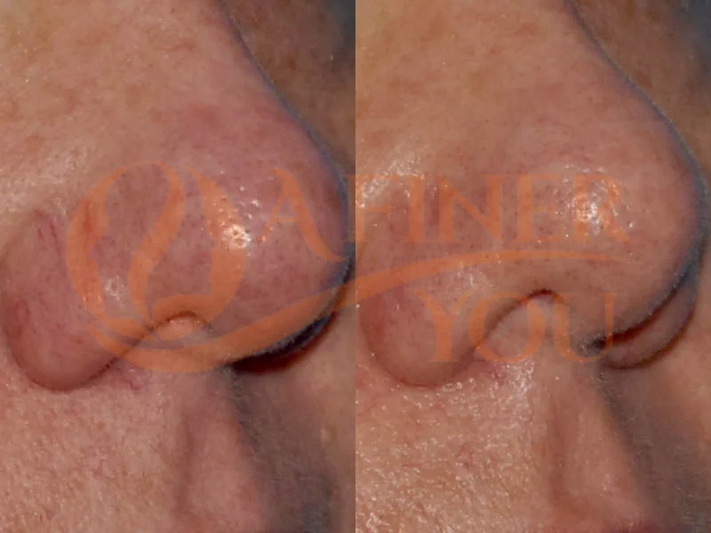 Cautery nasal blood vessel reduction 1 month result