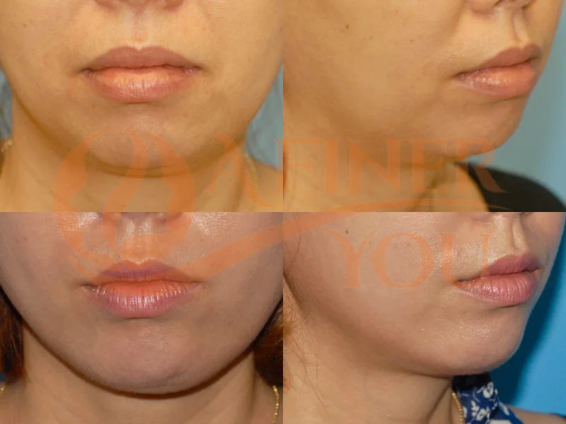 Chin implant 6 month result