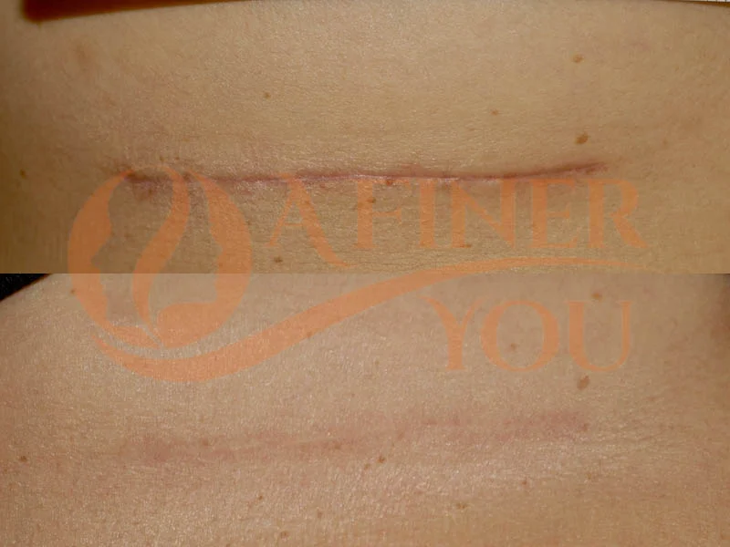 Inframammary fold scar reduction with multiple fractionated CO2 laser treatment 6 month after last treatment