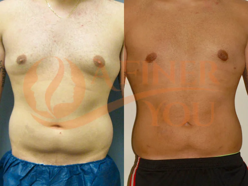 Gynecomastia reduction with liposuction and behind nipple tissue removal 6 month result