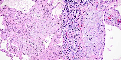 research-fibrosis.jpg