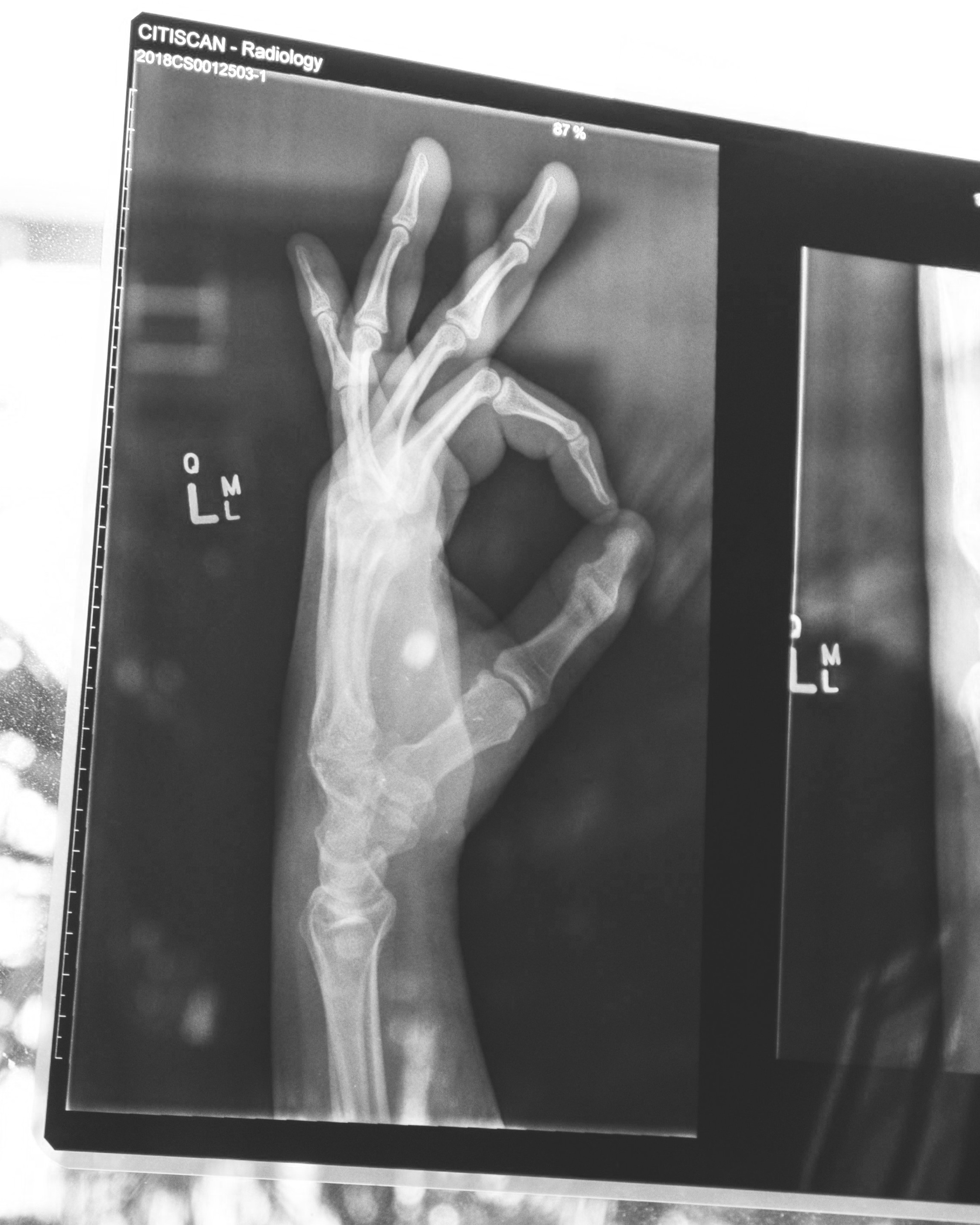 Ok+Hand+Finger+Pain.jpg