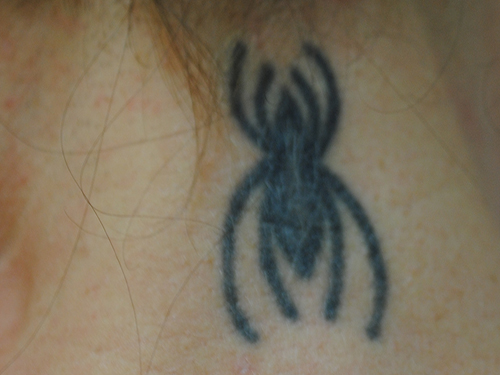01a-Tattoo-Removal-Oregon-Before.jpg