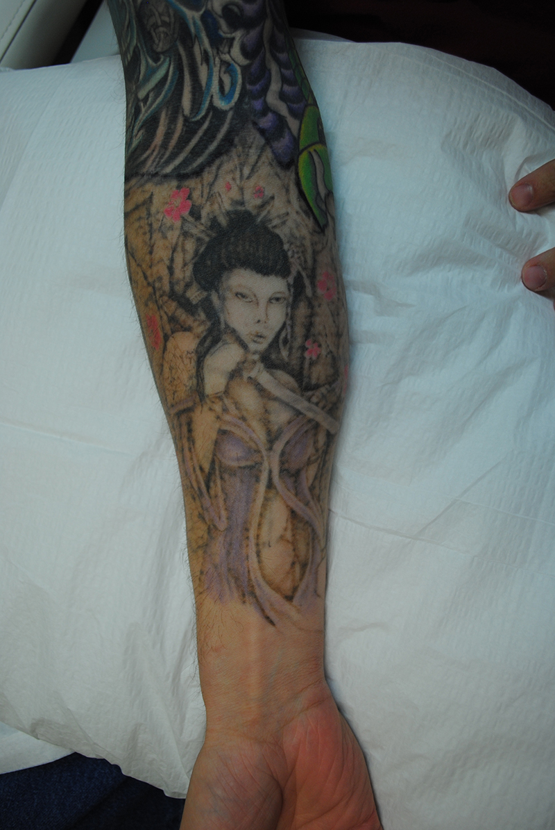 02-Tattoo-Removal-Oregon-Before.jpg