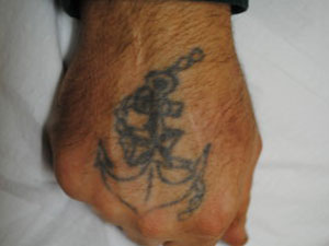 04-Tattoo-Removal-Oregon-Before.jpg