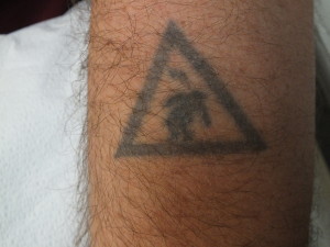 06-Tattoo-Removal-Oregon-Before.jpg