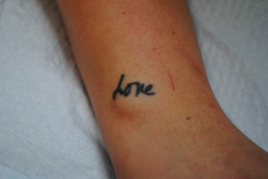 08-Tattoo-Removal-Oregon-Before.jpg