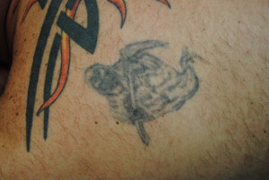 11-Tattoo-Removal-Oregon-Before.jpg