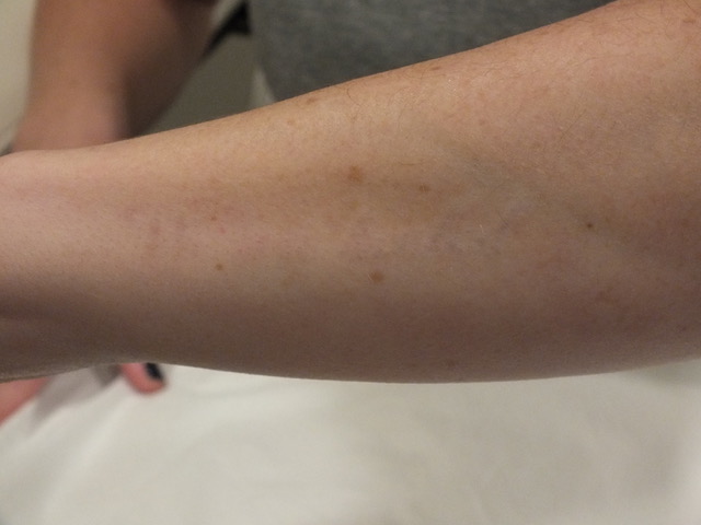 15b-Tattoo-Removal-Oregon-After.jpg