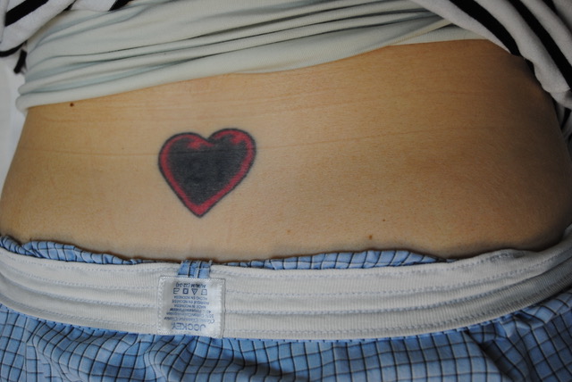 16-Tattoo-Removal-Oregon-Before.jpg