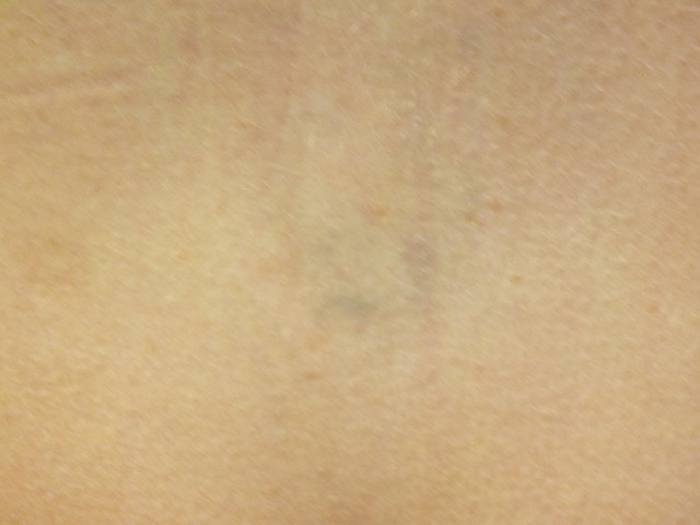 16b-Tattoo-Removal-Oregon-After.jpg