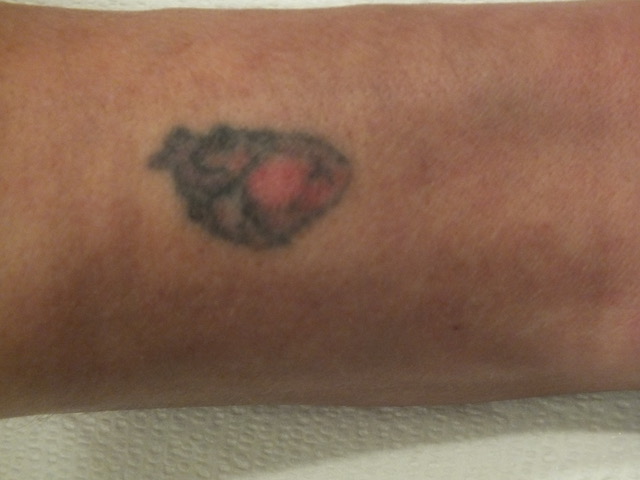 17-Tattoo-Removal-Oregon-After.jpg