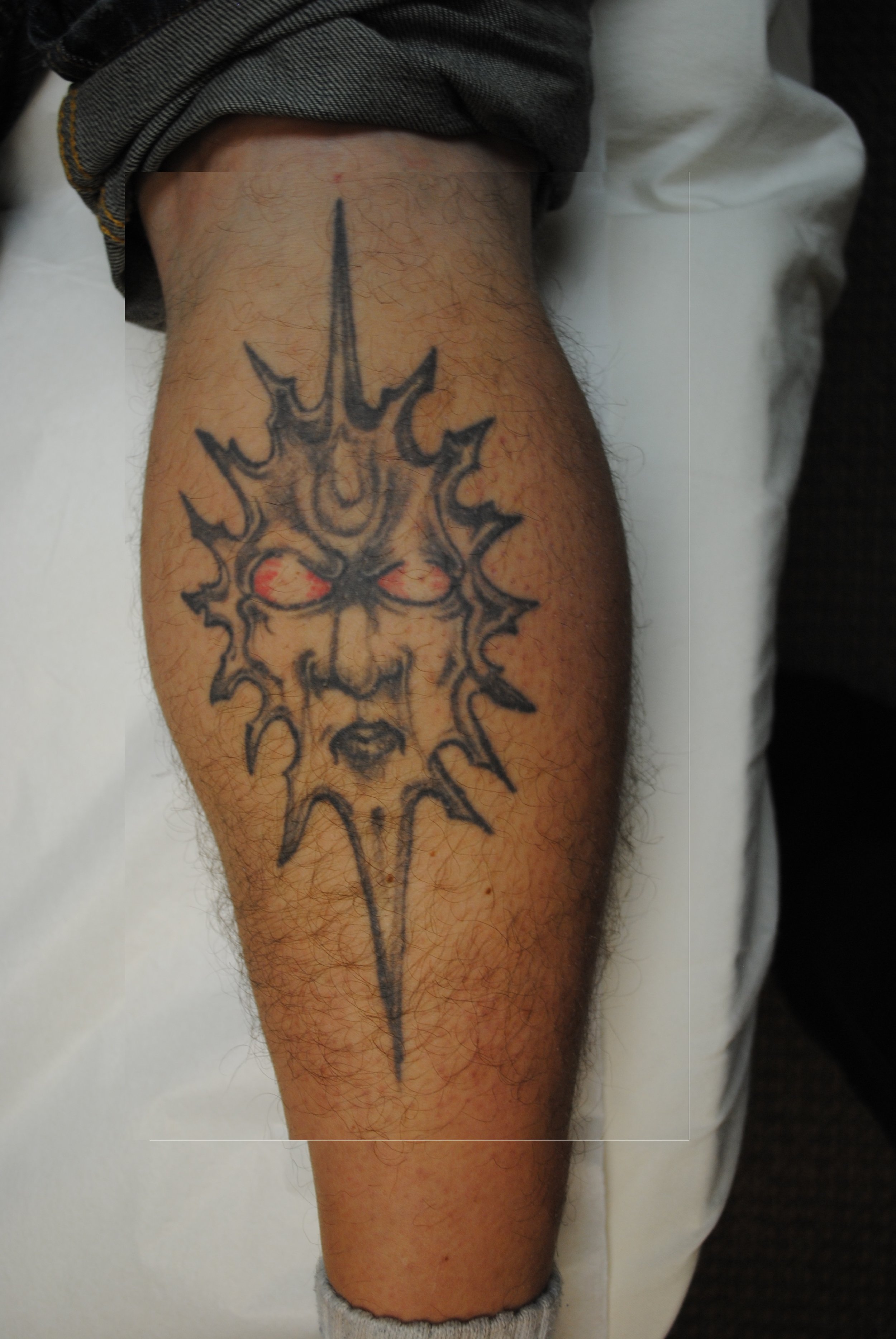 21-Tattoo-Removal-Oregon-Before.jpg