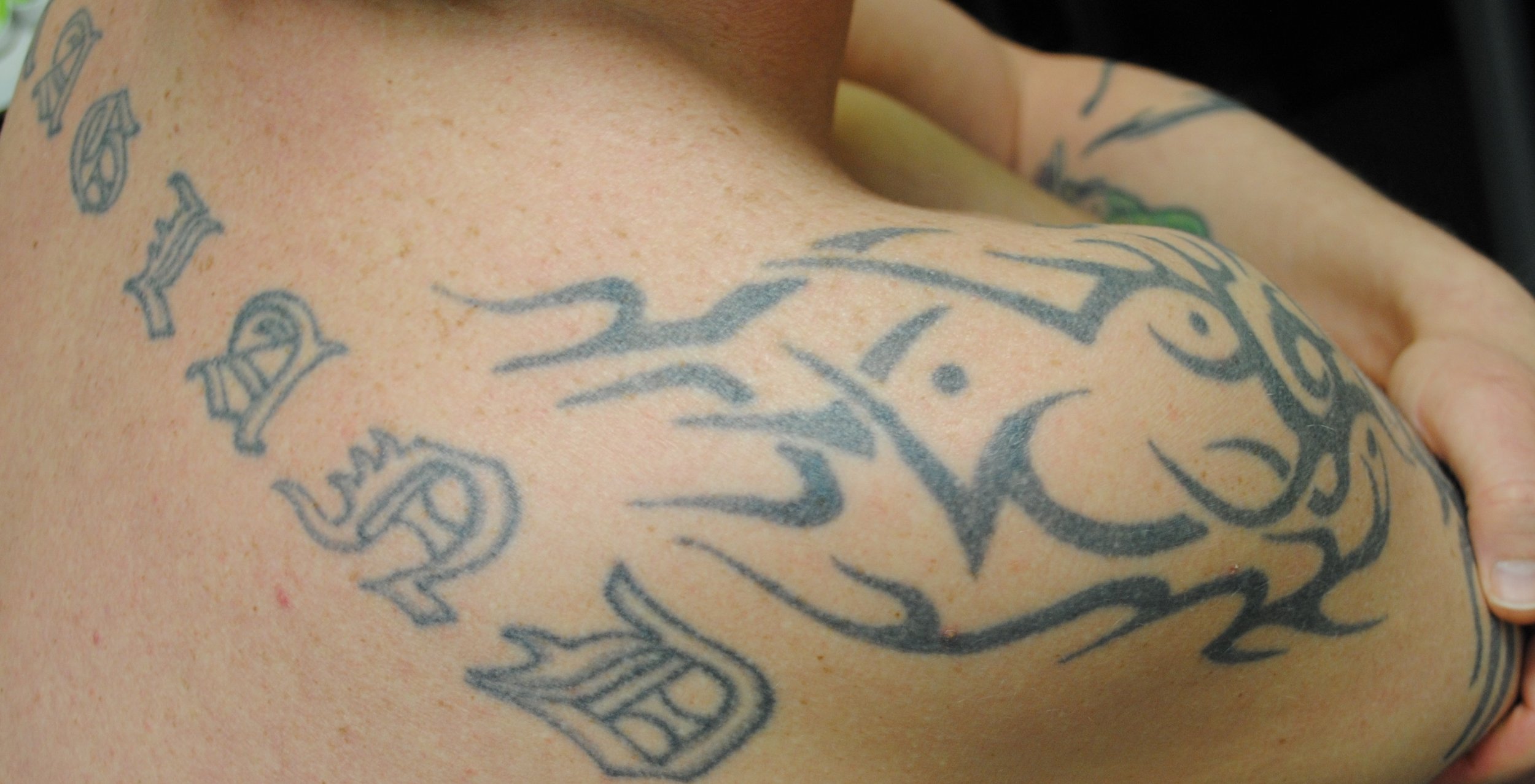 23-Tattoo-Removal-Oregon-Before.jpg