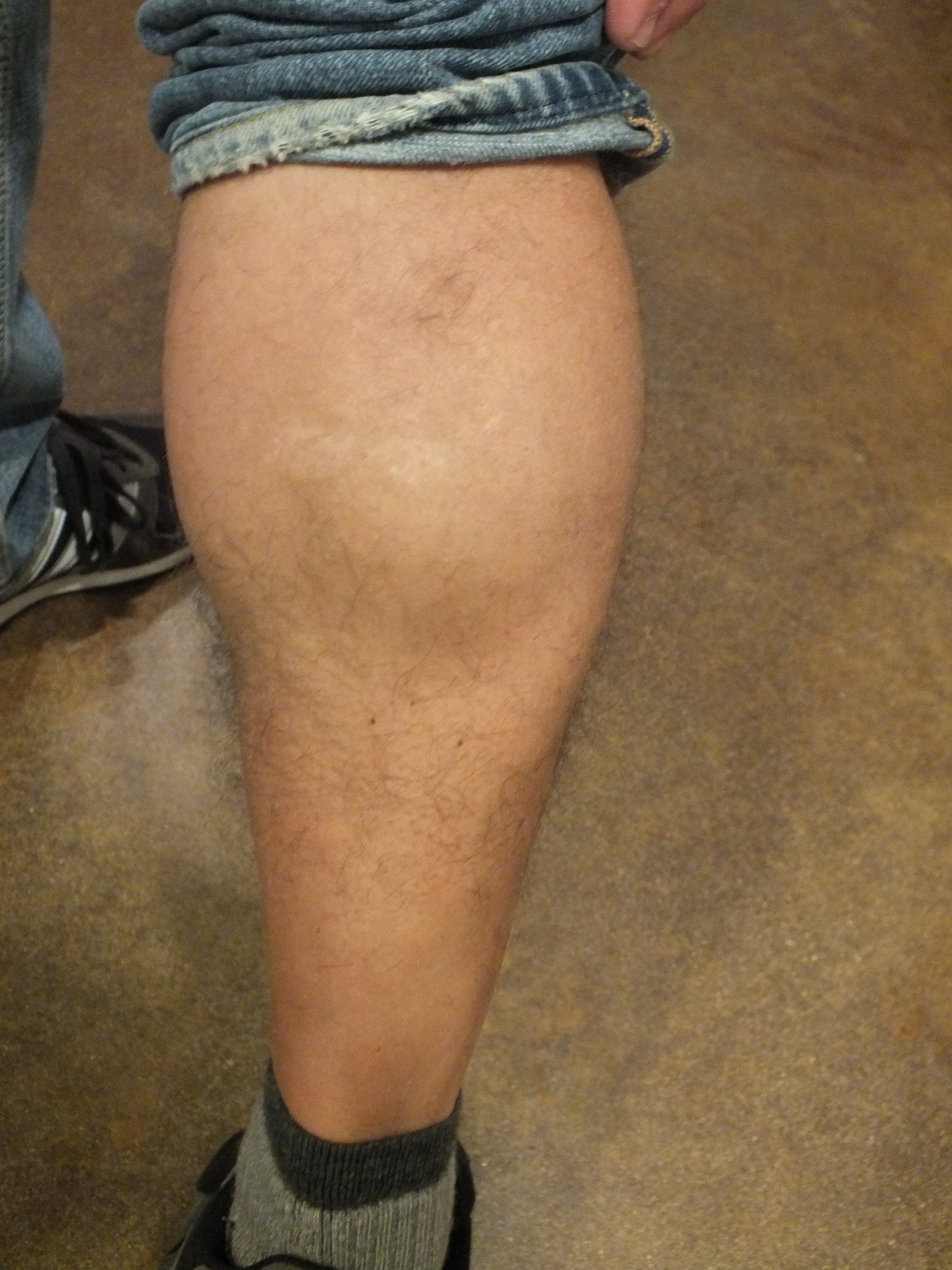 21b-Tattoo-Removal-Oregon-After.jpg