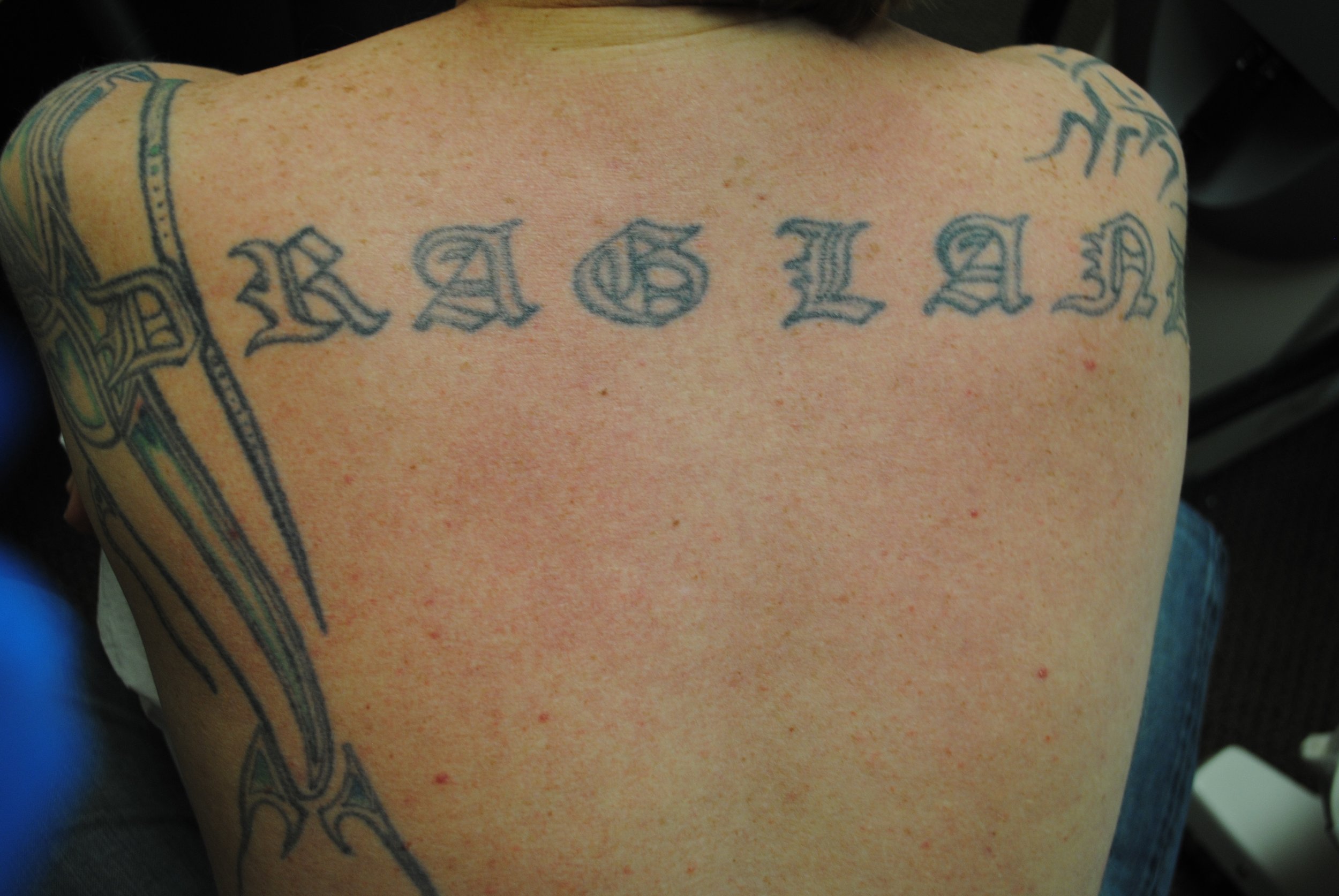 24-Tattoo-Removal-Oregon-Before.jpg