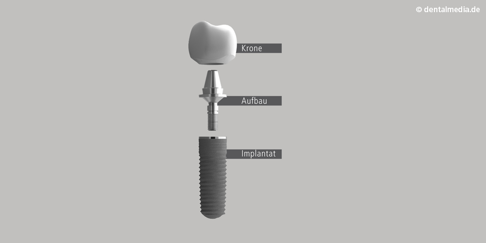 implantataufbau.png