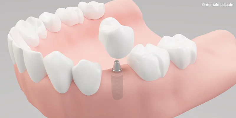 Ein Zahn fehlt. Ein Implantat hat gegenüber einer Brücke den Vorteil, dass Nachbarzähne nicht beschliffen werden müssen.